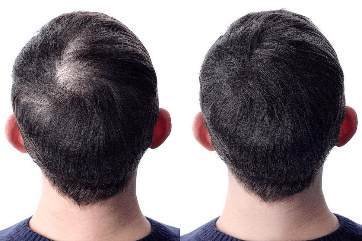 An Overview Of Hair Transplant
