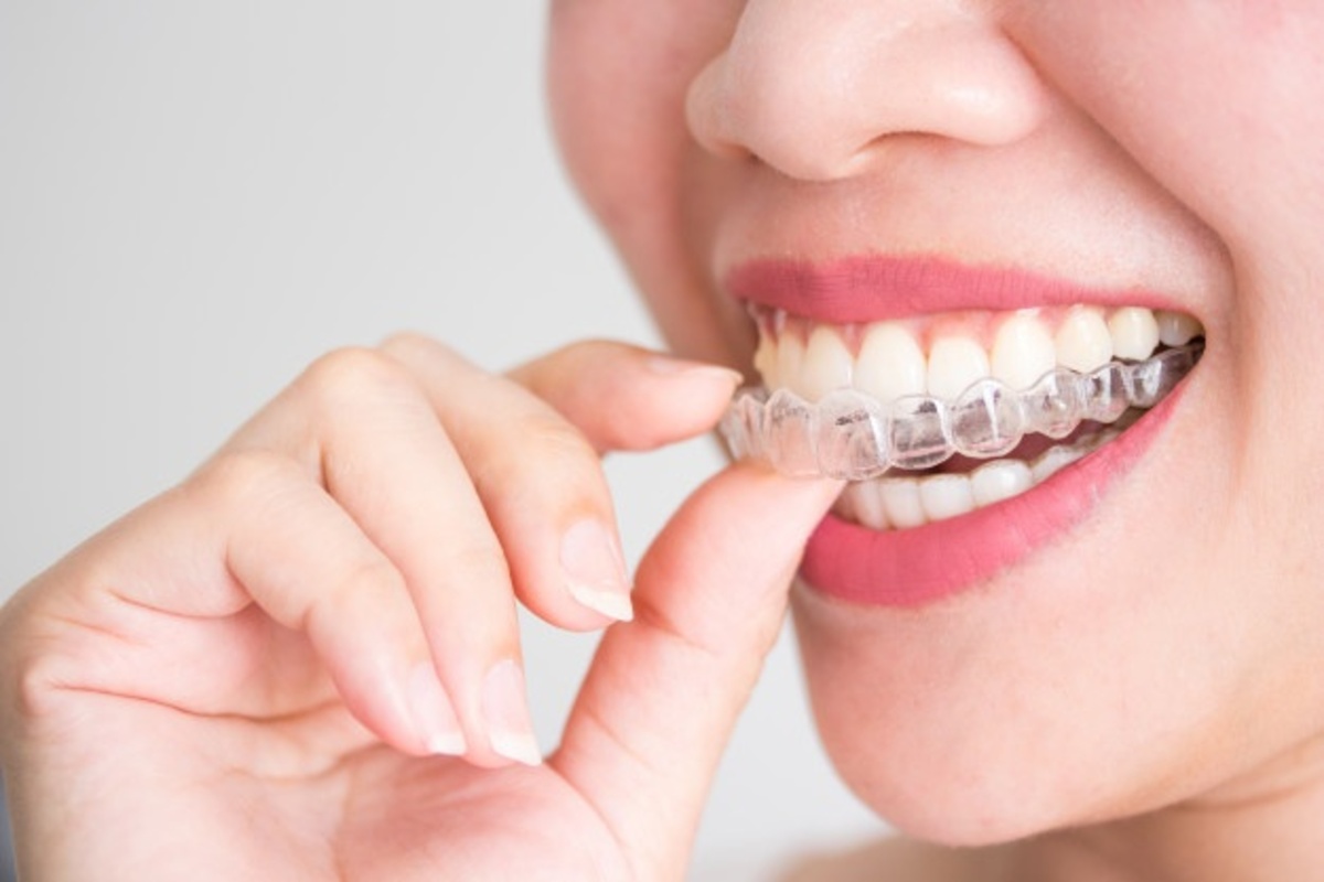 Complete Analysis On Invisalign Clinic