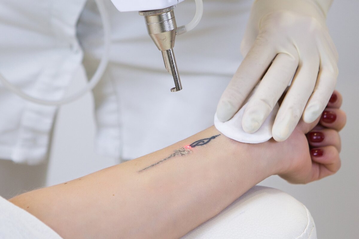 A Few Facts About Laser Tattoo Removal