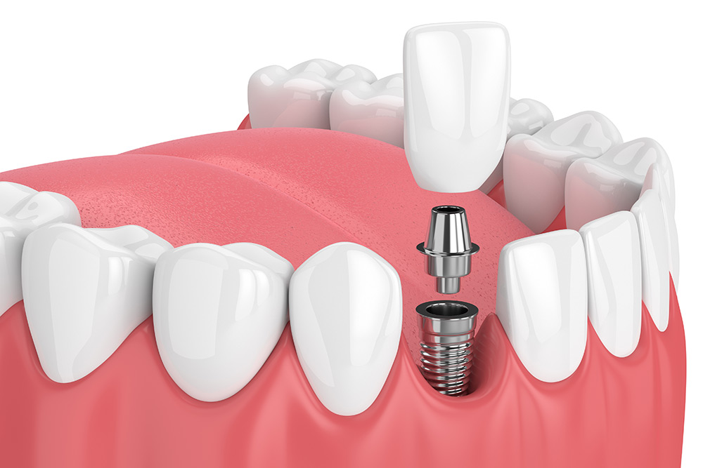 Complete Analysis On Tooth Implants