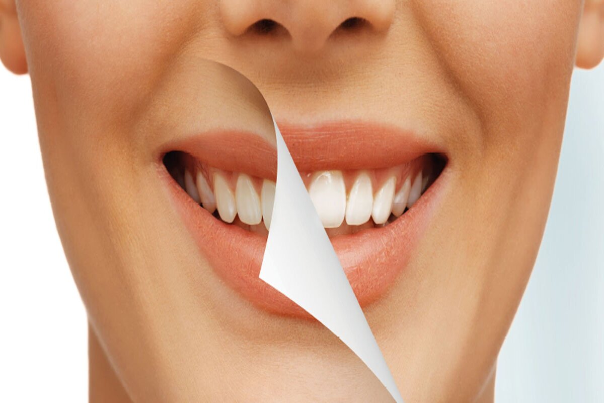 Complete Analysis On The Teeth Whitening