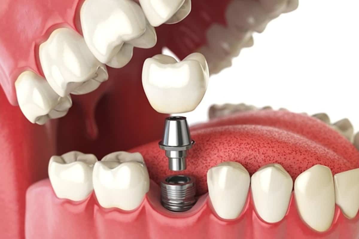 Closer Look On Affordable Dental Implants