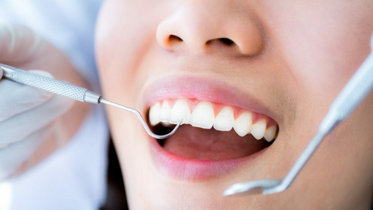 Features About Dental Cleaning