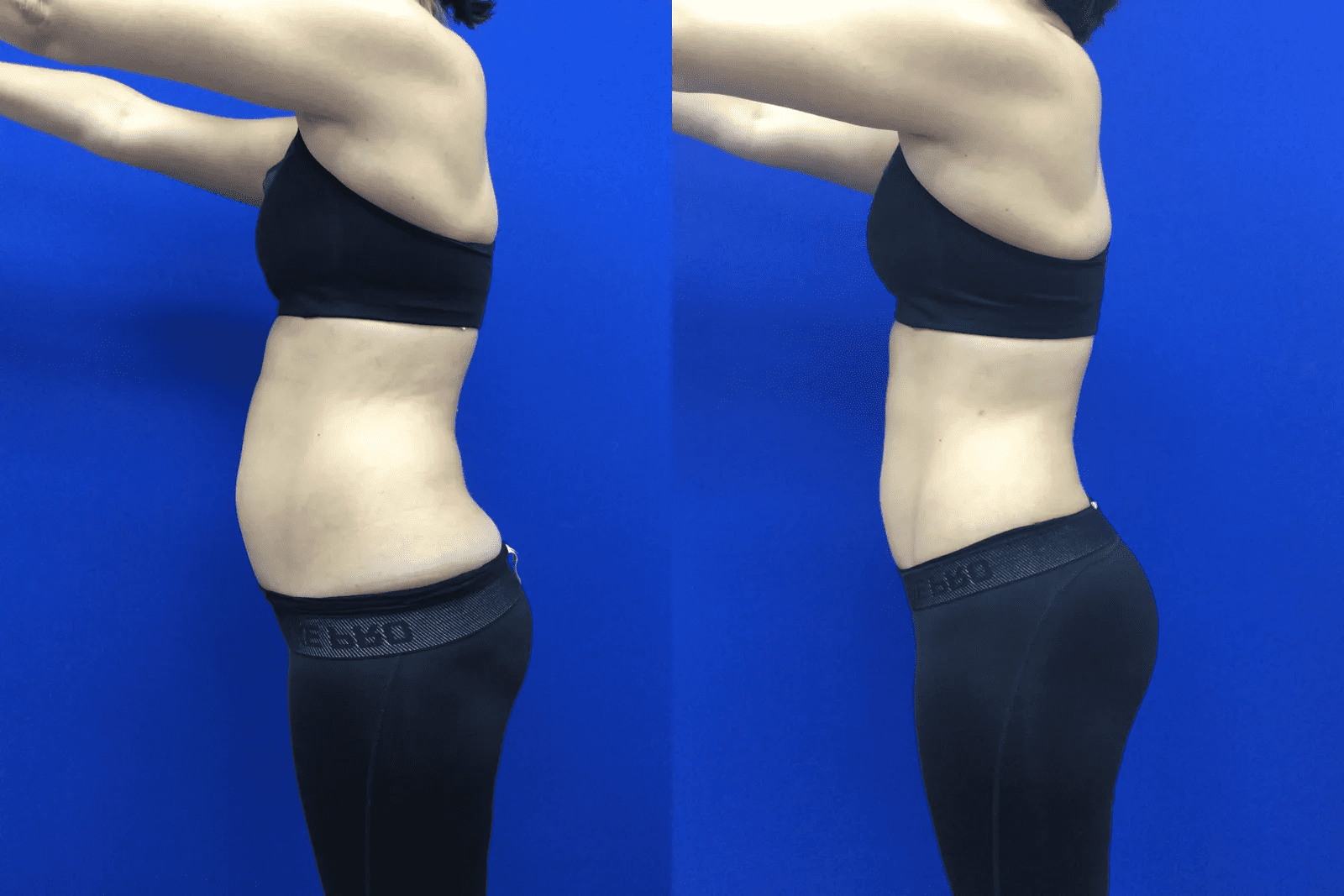 Advantages Of Water Lipo